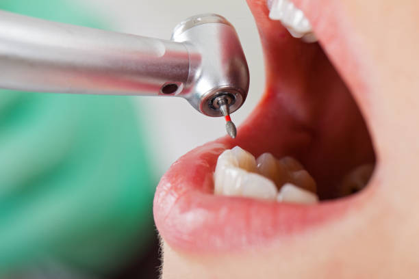 Best Emergency Tooth Extraction in Yellville, AR